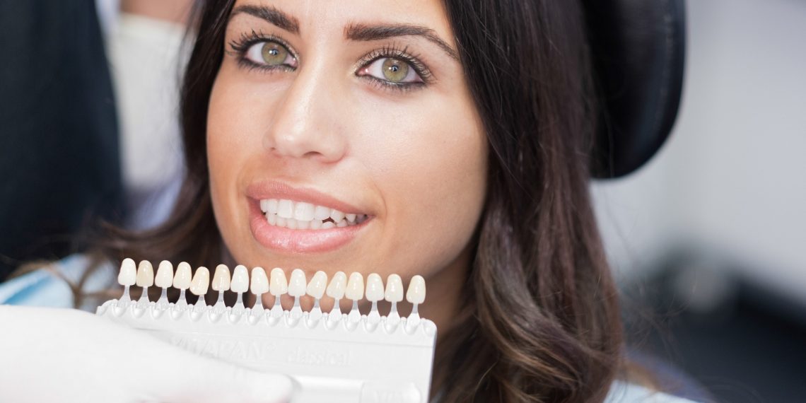 Gorgeous Smiles: How Long Do Veneer Teeth Last?