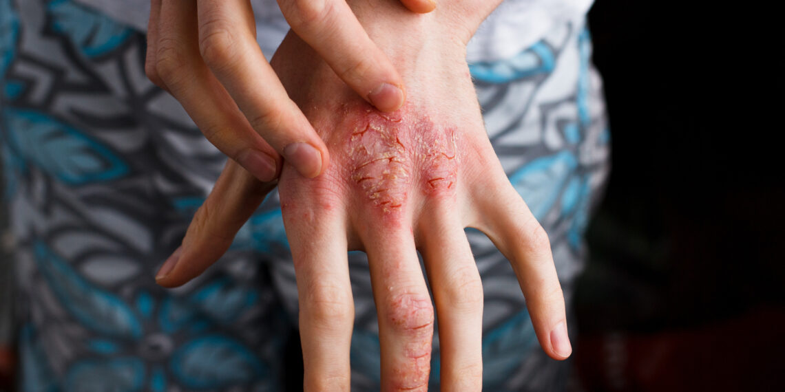 Psoriasis or eczema on the hand. Atopic allergy skin with red spots