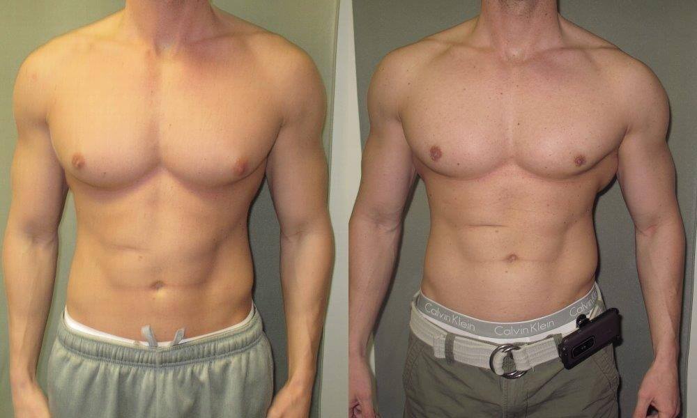 Gynecomastia Understanding The Causes Symptoms Treatment And Prevention Rijal S Blog