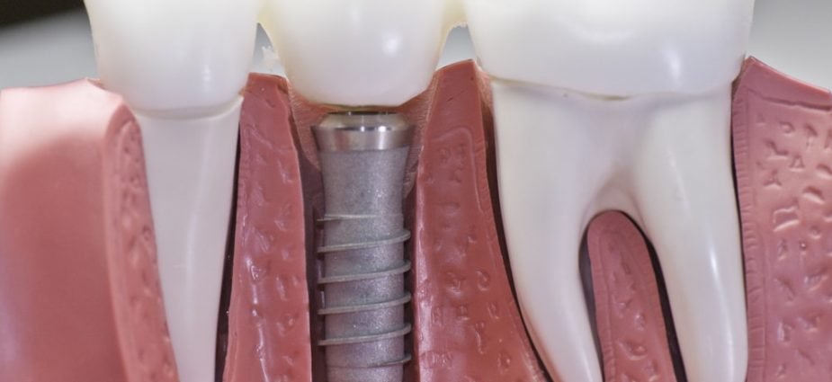 Types of dental implants