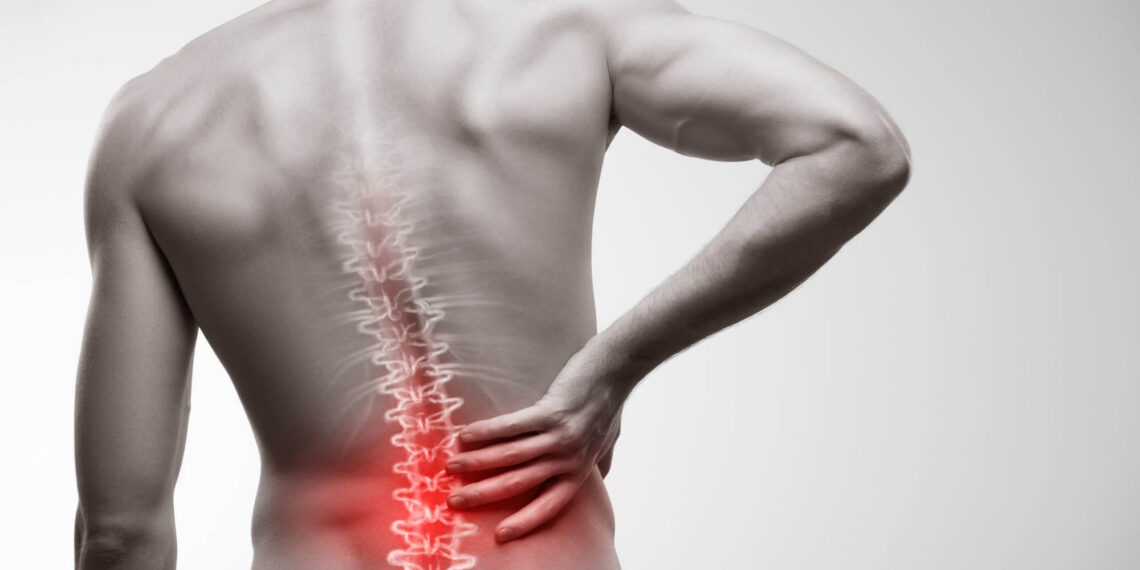 Severe Back Injury: VA Disability Rating for Back Injury