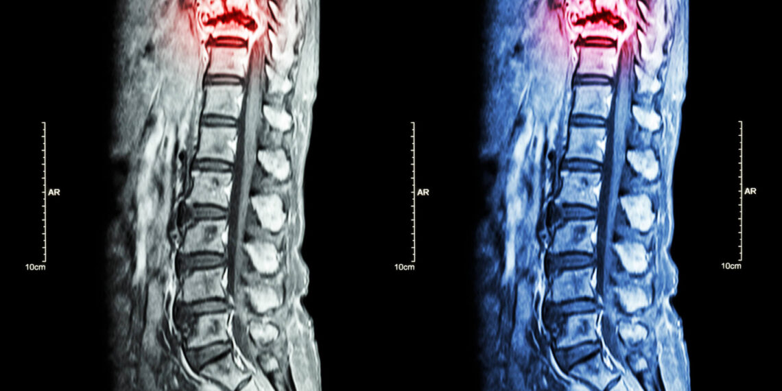 Spine Procedures