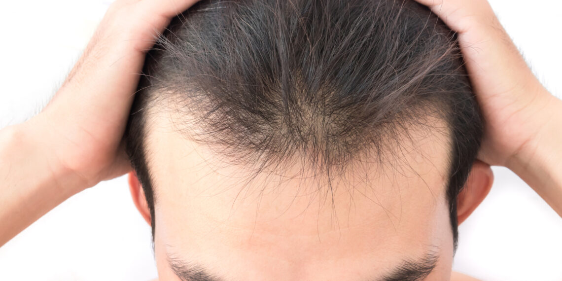 PRP for Hair Loss: Does It Work?