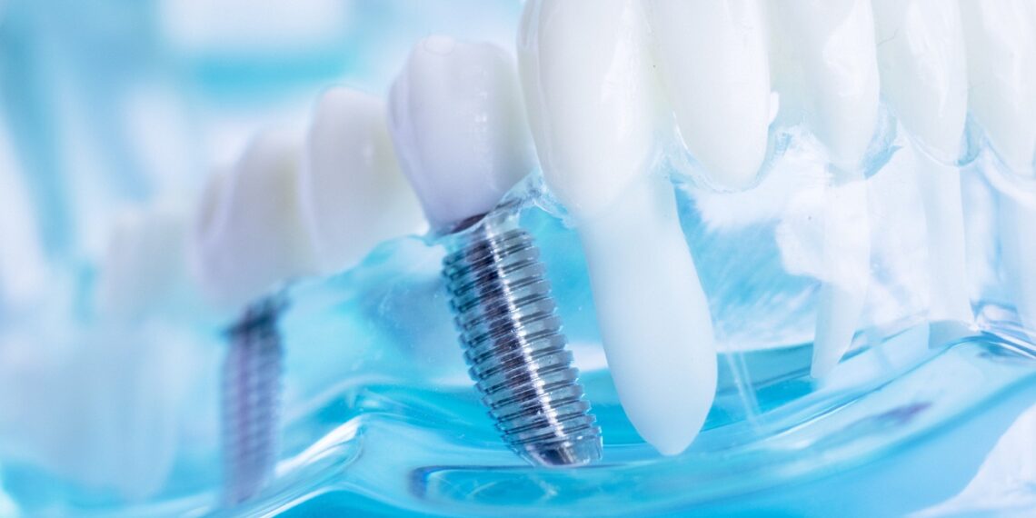All About Dental Implant Insurance Coverage