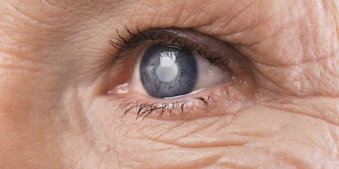 Cataract concept. Senior woman's eye, closeup