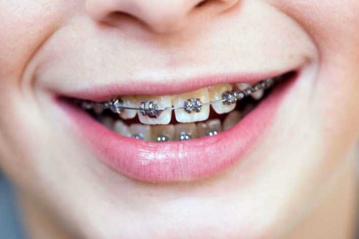 Risks Associated With Dental Braces