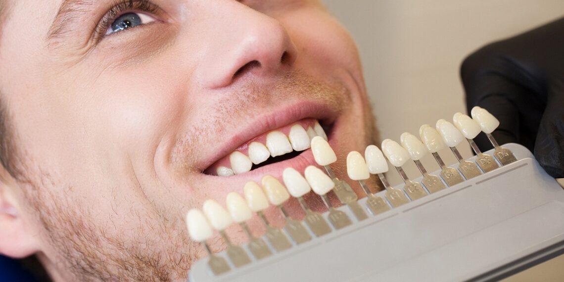 How Long Do Dental Implants Last? A Quick Guide