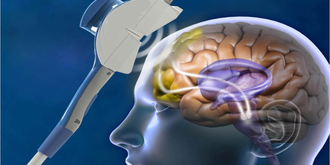 What is Transcranial Magnetic Stimulation