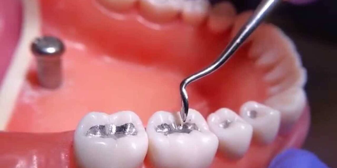 What is an Amalgam Filling