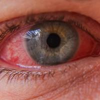 Understanding Pink Eye: Causes, Symptoms, and Effective Management