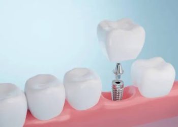 How to Maintain Healthy Dental Implants for a Lifetime