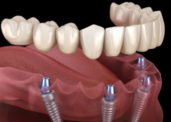 Long-Term Benefits of Full-Mouth Dental Implants