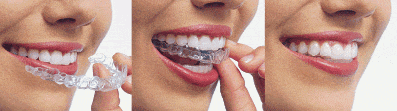 Best Invisalign Dentist NYC