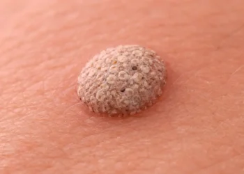 What Genital Wart Treatment Actually Removes