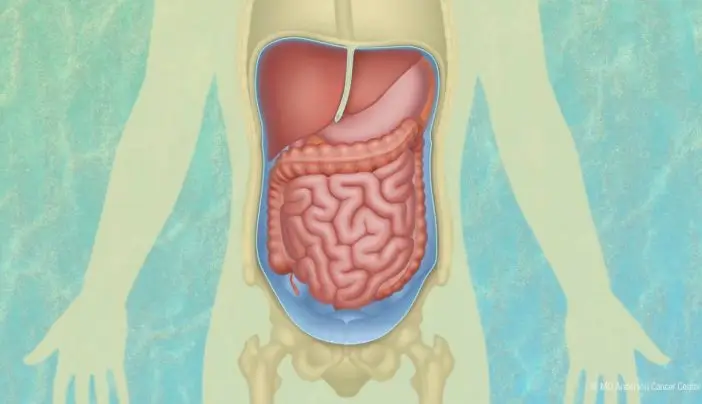 Peritoneal Mesothelioma