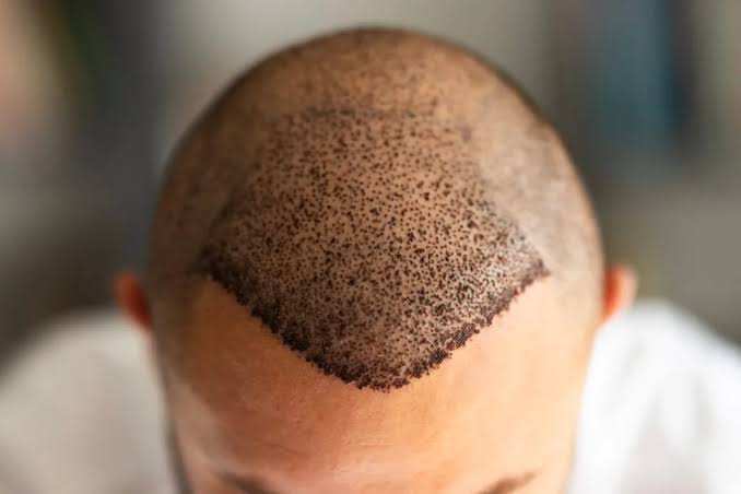 How to Plan Your Hair Restoration Journey in Turkey